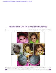 Various hormones cause hair loss (1). Pdf Reversible Hair Loss Due To Levothyroxine Overdose