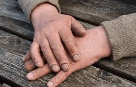 Image result for Hand Infection