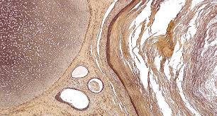 Flujo Marron Causas Consecuencias Sintomas Y Casos Unisima Com