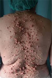 Therapeutic Approach to Plexiform Neurofibromas | IntechOpen