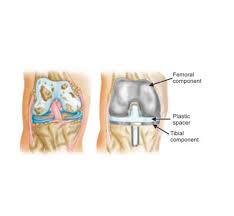 Use zocdoc to find knee pain specialists near you. Dr Vijay Chandar Best Hip Replacement And Knee Replacement Surgeon P M Santosha Hospital Multispecialty Hospital Best Orthopedic Doctor In Bangalore Best Knee Joint Replacement In Karnataka Best Orthopedic Doctor Near Me Best Knee