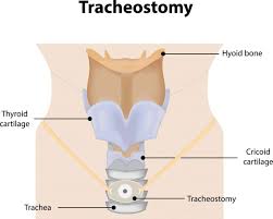 Image result for Tracheostomy