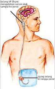 Vp Shunt Brain And Spine Center