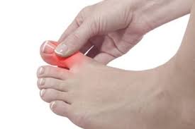 Taraklı ayak nedir nasıl olur taraklı ayaklar nasıl i̇ncelir. Ayak Ve Ayak Bilegi Hastaliklari Prof Dr Umut Yavuz Ortopedi Ve Travmatoloji Uzmani