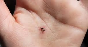 Give you support and strength while your skin closes up. Does Your Child S Cut Need Stiches Babycenter