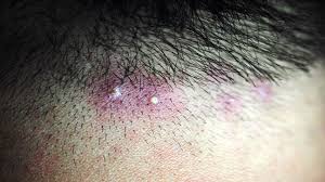 Image result for white scabs on the head in children
