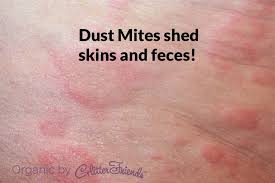 Dust Mites Bed Bug Bites Bed Bug Bites Pictures Bed Bug Remedies
