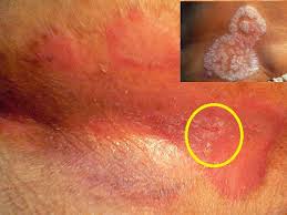 Inverse Psoriasis Reverse Psoriasis Treatment