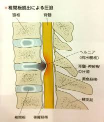 頚椎椎間板ヘルニア”とはなんなのか？ | つかさはりきゅう整骨院のモモBlog