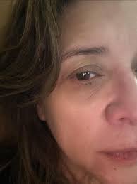 Does it look like I've been crying? Because I have…. I went to the ER &  it's not great news. An ophthalmologist saw me right away & said that the  intraocular lens