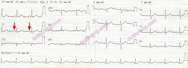 • hemoptysis can occur for a variety of reasons: Mitral Stenosis And The Ecg Mitral Darligi Ve Ekg Mitral Stenoz Ekg Ecg Ankara Kardiyoloji Kalp Hastaliklari Mete Alpaslan Doktorekg Com