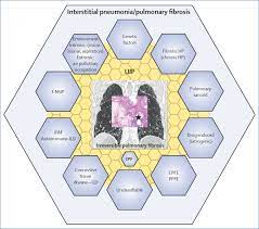 Idiopathic Pulmonary Fibrosis Shifting The Concept To Irreversible Pulmonary Fibrosis Of Many Entities The Lancet Respiratory Medicine