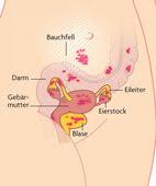 Woran Sie Eine Endometriose Erkennen Apotheken Umschau