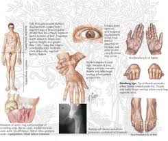 Inoltre, come accade per altri disturbi dello spettro autistico, anche chi è asperger … Yo Tambien Tengo El Sindrome De Marfan Photos Facebook