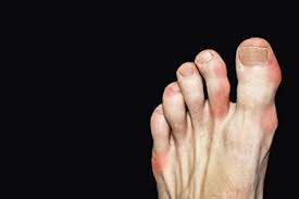 Image result for gout