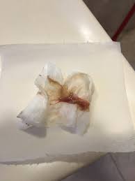 Mucus Plug After A Cervical Exam Tmi April 2019 Babies Forums What To Expect