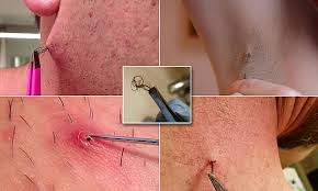 Your best bet is to simply do a few things that will help the hair come out on its own faster. Ingrown Hair Extraction Is Eclipsing Pimple Popping Porn Daily Mail Online