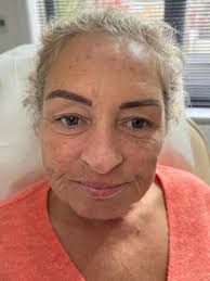 When Vicki came to me she hadn't had any aesthetic treatments, this is her  tweakment journey. — Samantha Carron Aesthetics Ltd