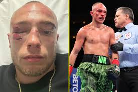 Sunny Edwards shows off gruesome injuries after stoppage defeat to Jesse  'Bam' Rodriguez and was worried about eyesight