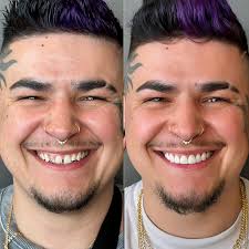 Just absolutely loving this life changing smile transformation. One of my  favorites ever! 10 porcelain veneers to create this amazing smile. He's  told me not a day goes by that he doesn't