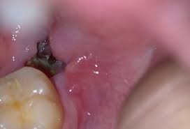 Your dentist will be able to determine the seriousness of the infection. So I Have Dry Socket Is It Infected Or Healing Well 9 Days After Wisdom Tooth Extraction