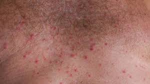 Image result for heat rash under breasts