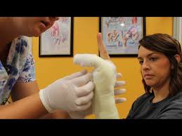 Image result for Ulnar Gutter Cast