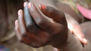 Gangrene is when part of your body tissue dies. Que Es La Gangrena Y Cuales Son Las Causas Canal Salud