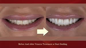 Maybe you would like to learn more about one of these? Veneers At Best Dentist In Essex Start Smiling