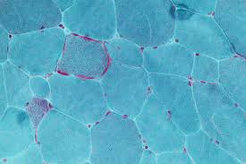 Mitochondrial Disease Wikipedia