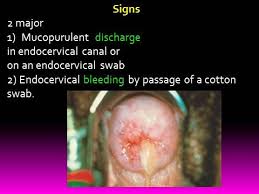Image result for Acute Cervicitis