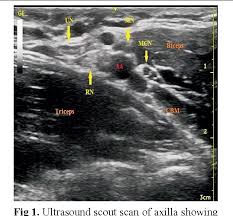 Image result for Axillary Nerve Block