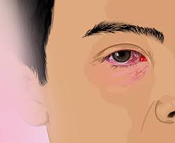 Image result for Ciliary Flush