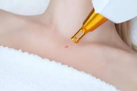 Verrugas Que Hacer Si Aparecen En El Cuerpo