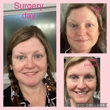 Hello! I wanted to ask you if any of you have had lower back pain, a  herniated disc or something similar and if this could be the cause of  BII?😓😪 and when