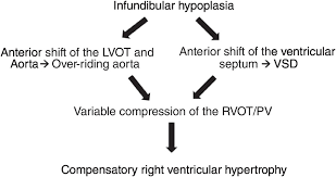 Some findings from the ultrasound may make the health care provider suspect a baby may have tetralogy of fallot. Tetralogy Of Fallot Chapter 64 Case Studies In Pediatric Anesthesia