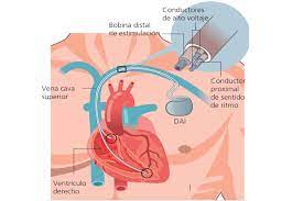 Se te implanta un desfibrilador cardioversor implantable en el pecho y se conecta a tu corazón a través. Desfibrilador Automatico Implantable Dr Yitzar Banuelos Millan