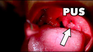 Mar 25, 2019 · swollen tonsils are caused by viruses, such as: Giant Tonsils With White Pus Strep Throat Mono Dr