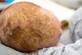 Image result for Cradle Cap