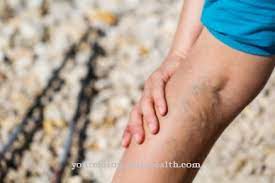 Система верхней полой вены ( vena cava superior ). Vena Varikos Penyebab Rawatan Pertolongan Gejala