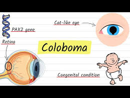 Image result for Coloboma