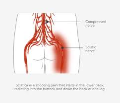 Buttock, low back, posterior crest of ilium, sacrum. Sciatica Spine Surgery