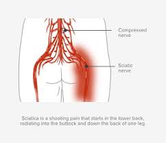 The pelvis at the bottom of the back and the shoulders at the top of the back give the back its breadth, and it narrows in between these two regions. Sciatica Huffman Spine Clinic