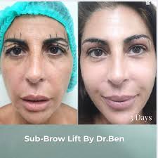 ✨ Sub-Brow Lift by Dr. Ben ✨ Only 3 days post-op and the difference is  incredible! This procedure beautifully lifts the skin just beneath the  eyebrows — reducing upper eyelid sagging, refreshing