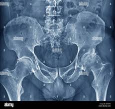 Image result for Hip XRay