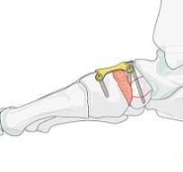 Primary fusion of naviculocuneiform joint for Complete ...