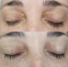Image result for xantelasma