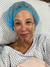 Face-lift & Neck-lift Support Group