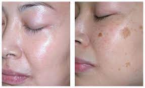Apabila anda terkena batuk kokol, maka harus waspada dengan ubat sembarang jual untuk mengubati batuk kokol. Petua Menghilangkan Jeragat Di Muka Dengan Lebih Berkesan