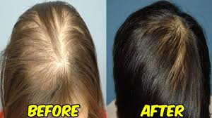 Follicles aren't able to grow with full vigor. How To Use Black Seed Oil Kalonji For Hair Growth And Baldness 100 Works Youtube